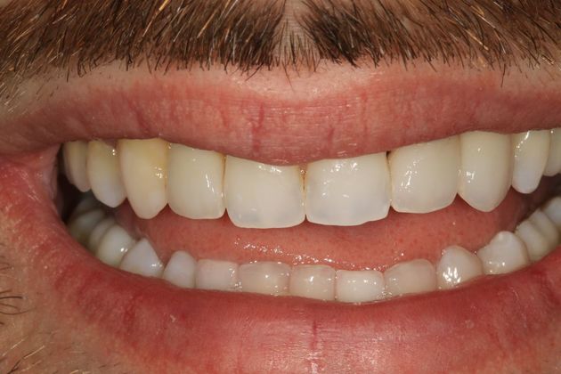 Full Mouth Rehabilitation: Samir - Before