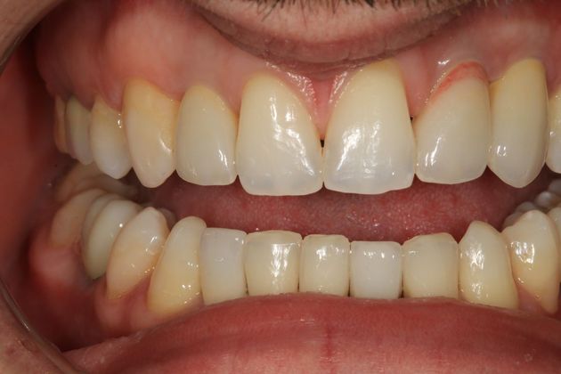 Full Mouth Rehabilitation: Samir - After