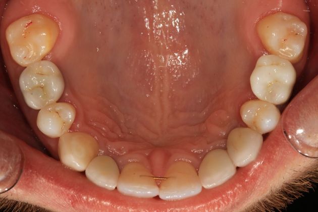 Full Mouth Rehabilitation: Samir - After