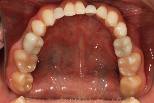 Full Mouth Rehabilitation: Samir - After