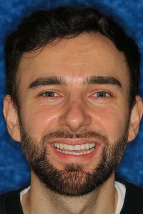 Full Mouth Rehabilitation Samir