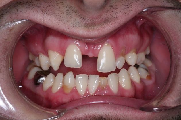 Full Mouth Rehabilitation: Samir - Before