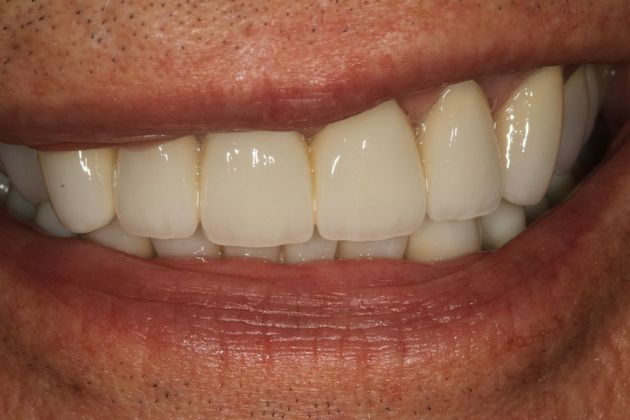 Full Mouth Rehabilitation: Ron - After