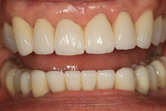 Full Mouth Rehabilitation: Ron - After