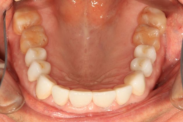 Full Mouth Rehabilitation: Ron - After