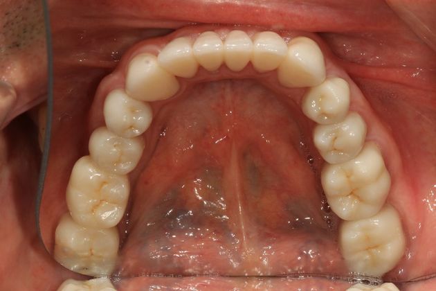 Full Mouth Rehabilitation: Ron - After
