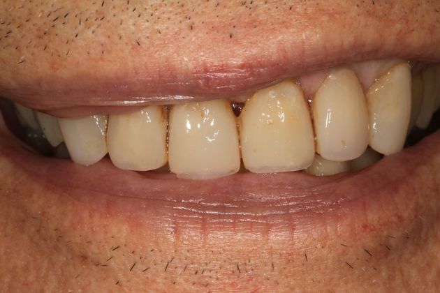 Full Mouth Rehabilitation: Ron - Before