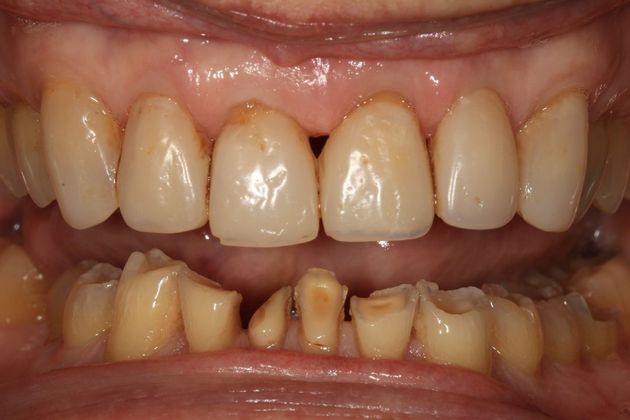 Full Mouth Rehabilitation: Ron - Before