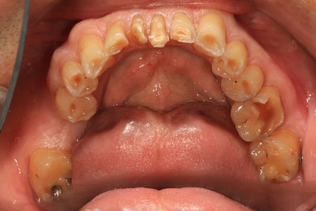 Full Mouth Rehabilitation: Ron - Before