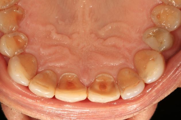 Full Mouth Rehabilitation: Ron - Before