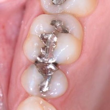 Tooth-colored Fillings: Case 10 - Ganado, TX - Before