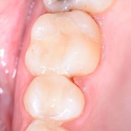 Tooth-colored Fillings: Case 10 - Ganado, TX - After