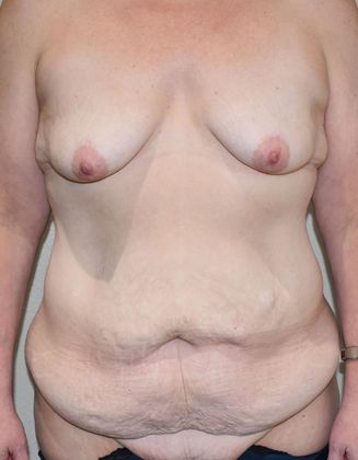 Mommy Makeover Case 145 - Before