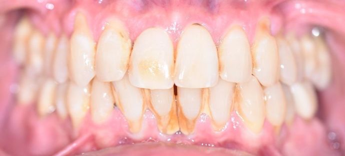 Periodontal Cleaning Case 3 - Port Lavaca, TX - Before