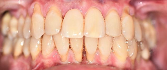 Periodontal Cleaning Case 3 - Port Lavaca, TX - After