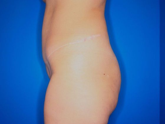 Abdominoplasty: Case 1 - After