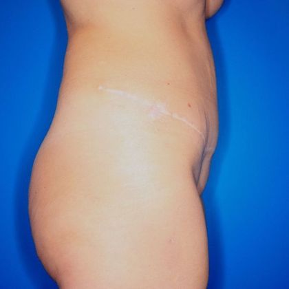 Abdominoplasty: Case 1 - After