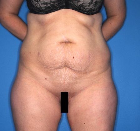 Abdominoplasty Case 1 - Before