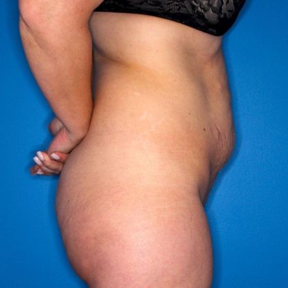 Abdominoplasty: Case 1 - Before