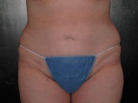 Liposuction: Case 4 - Indianapolis - After
