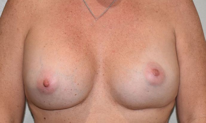 Breast Revision: Case 130 - Before