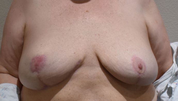 Breast Revision: Case 131 - After