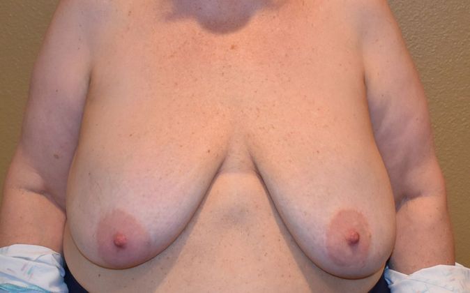 Breast Revision: Case 131 - Before