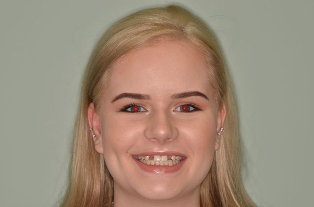 Dental Implants Case 32 - Before