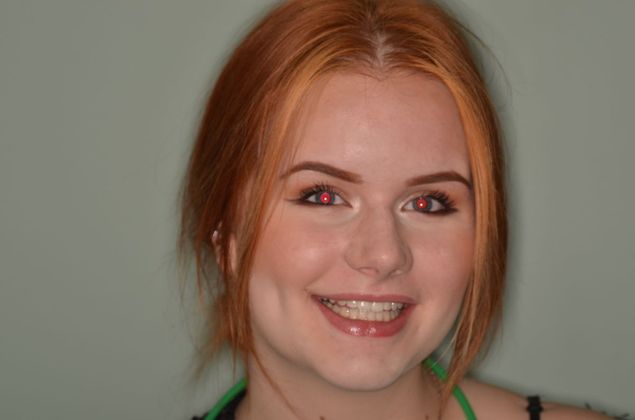 Dental Implants Case 32 - After