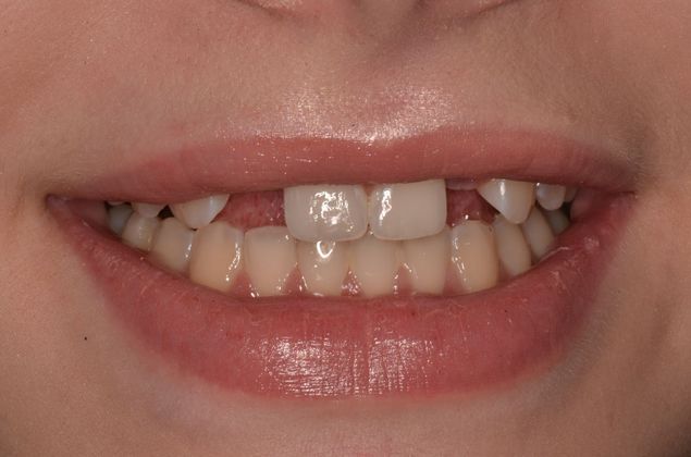 Dental Implants: Case 32 - Before