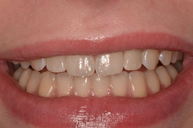 Dental Implants: Case 32 - After