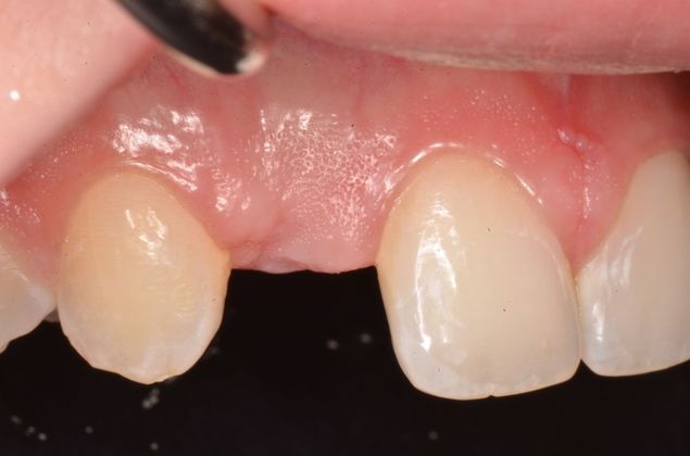 Dental Implants: Case 32 - Before