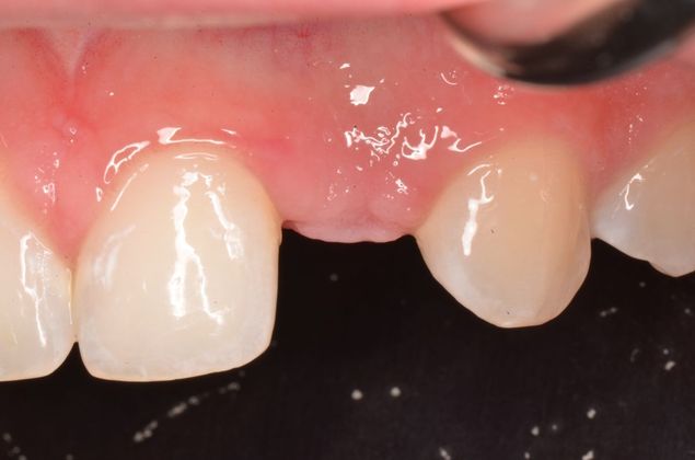 Dental Implants: Case 32 - Before