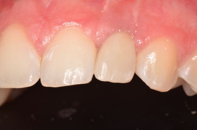 Dental Implants: Case 32 - After