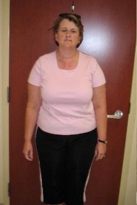 Patient Transformation Stories: Doyce’s Gastric Sleeve helped her lose 75 pounds in 7 months! - Before