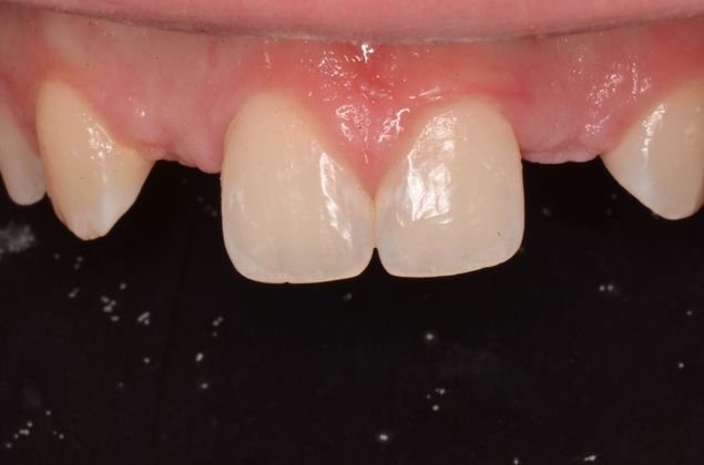 Dental Implants: Case 32 - Before