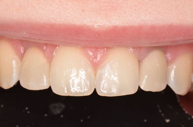 Dental Implants: Case 32 - After