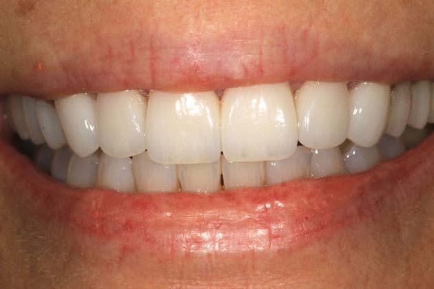 Porcelain Veneers: Elise - After