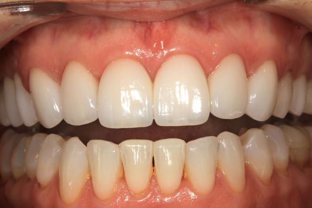Porcelain Veneers: Elise - After