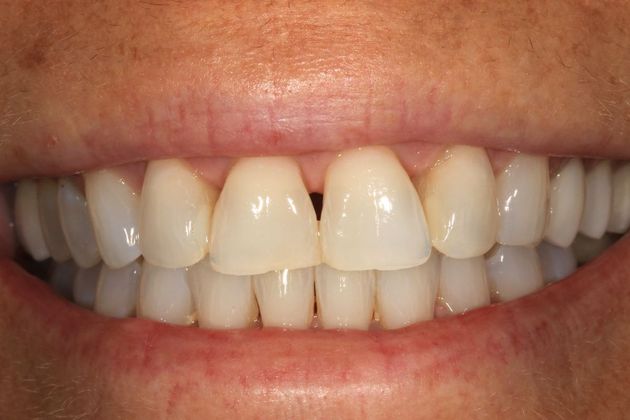 Porcelain Veneers: Elise - Before
