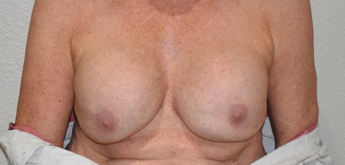 Breast Revision: Case 132 - Before
