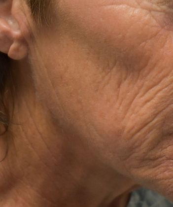 Facelift Case 10 - Before