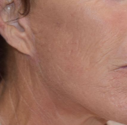 Facelift Case 10 - After