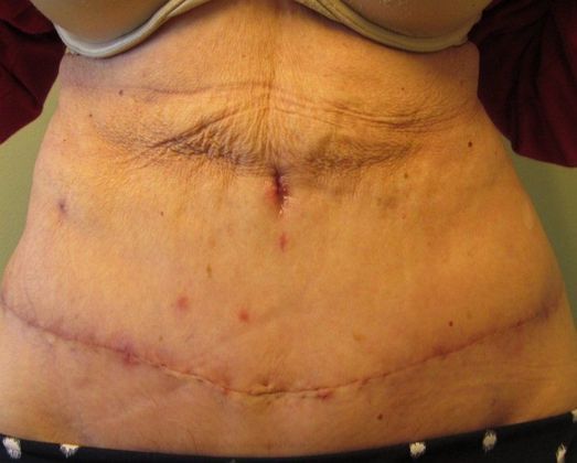Tummy Tuck: Case 20 Tummy tuck, Stratford - After