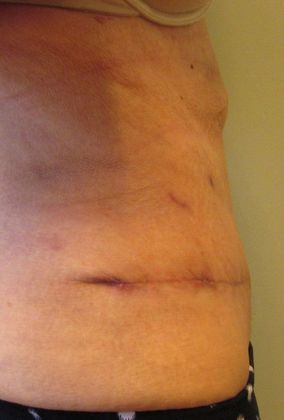Tummy Tuck: Case 20 Tummy tuck, Stratford - After
