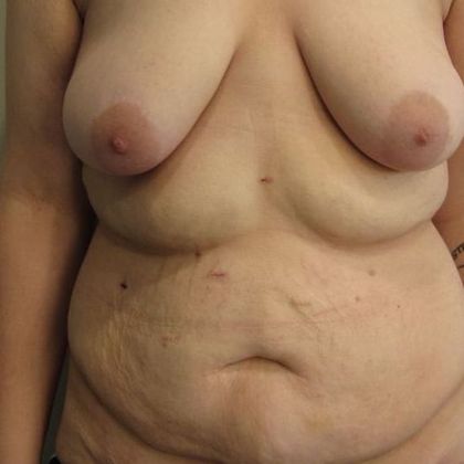 Tummy Tuck: Case 14 - Tummy Tuck, Fairfield - Before