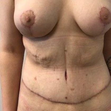 Tummy Tuck: Case 14 - Tummy Tuck, Fairfield - After