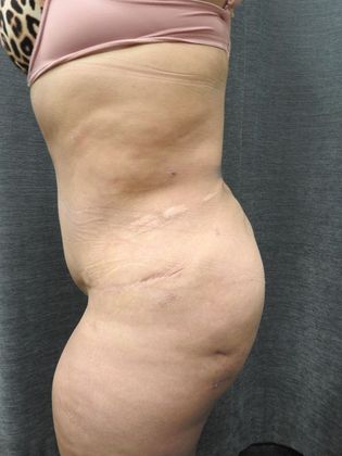Abdominoplasty Case 22 - San Antonio - After