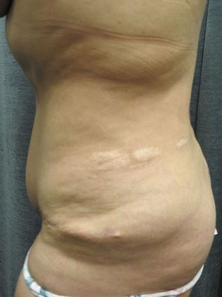 Abdominoplasty Case 22 - San Antonio - Before