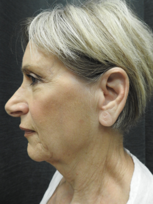 QuickLift Facelift before